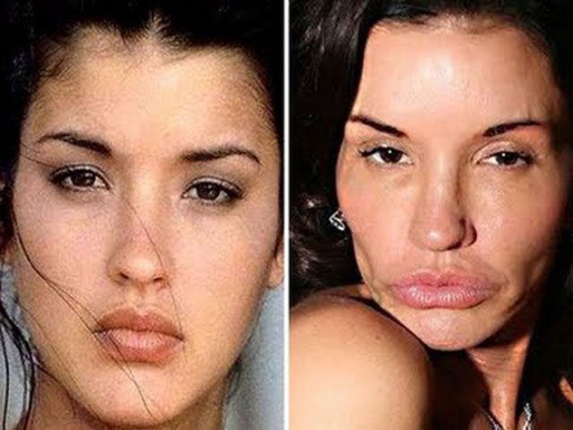 Photos de célébrités avant et après les opérations de beauté.